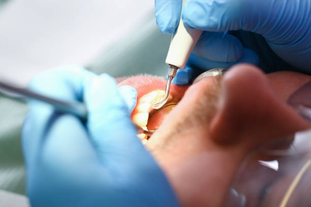 Best Emergency Wisdom Teeth Removal in Kekoskee, WI