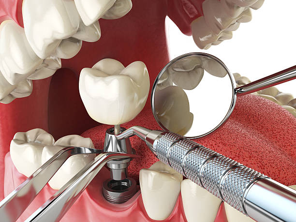 Best Emergency Tooth Extraction in Kekoskee, WI